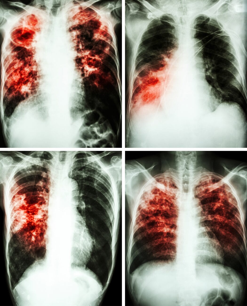 Chest x-rays.